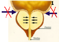 bph_treatment001003.gif