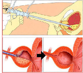 bph_treatment001004.jpg