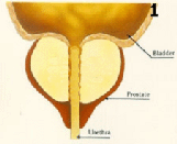 bph_treatment001005.gif