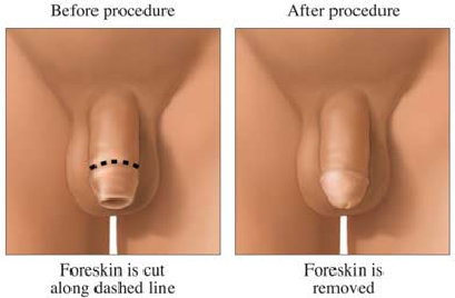 circumcision001008.jpg