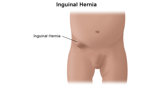 Hiatal Hernia Symptoms, Causes, Treatment.