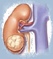 kidney_cancer001005.jpg