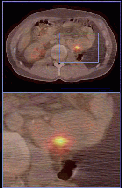 kidney_cancer001006.gif