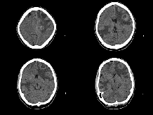 kidney_cancer001011.gif