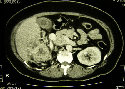 kidney_cancer001016.jpg