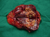 kidney_cancer001019.gif