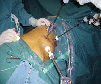 lap_nephrectomy001003.gif