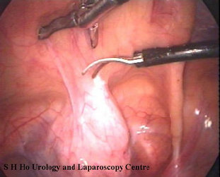 laparoscopy001009.jpg