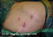 laparoscopy001010.jpg