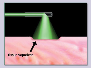 Demontere Hende selv hver for sig Green light laser surgery for prostate