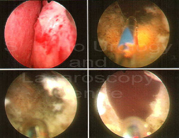 Demontere Hende selv hver for sig Green light laser surgery for prostate