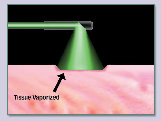 laser_surgery001003.jpg