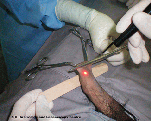 laser_surgery001004.gif