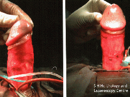 penile_surgery001001.gif