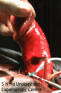 penile_surgery001003.gif