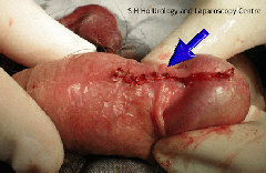 penile_surgery001008.jpg