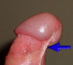 penile_surgery001010.jpg