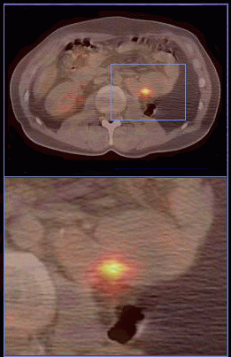 Steroid treatment brain tumors