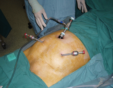 laparoskopy