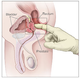 prostate_specific_antigen001001.jpg