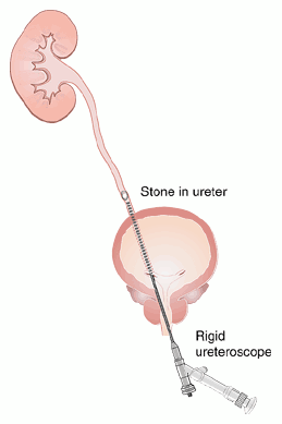 Pain After Laser Treatment For Kidney Stones