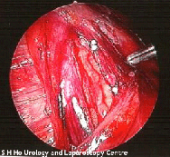 varicocele_treatment001004.gif