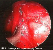 varicocele_treatment001005.gif