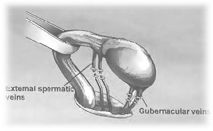 varicocele_treatment001008.jpg