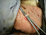 vasectomy001009.gif