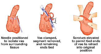 vasectomy001011.jpg