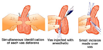 vasectomy001012.jpg